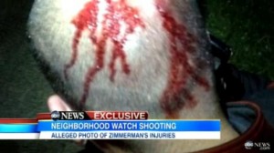 ZimmermanBloodyHead